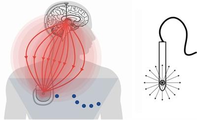 Electrocardiographic approach strategies in patients with Parkinson disease treated with deep brain stimulation